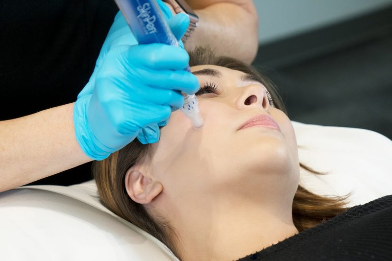 Microneedling treatment at Transformative Wellness